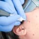 Akne Dermatologie Venerologie Wien - Startseite